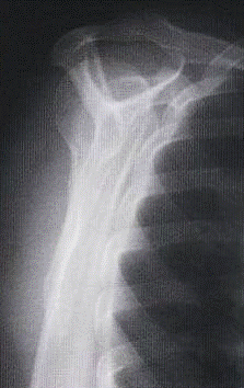 Radiografía Lateral Escápula